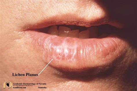 Lichen Planus Lips