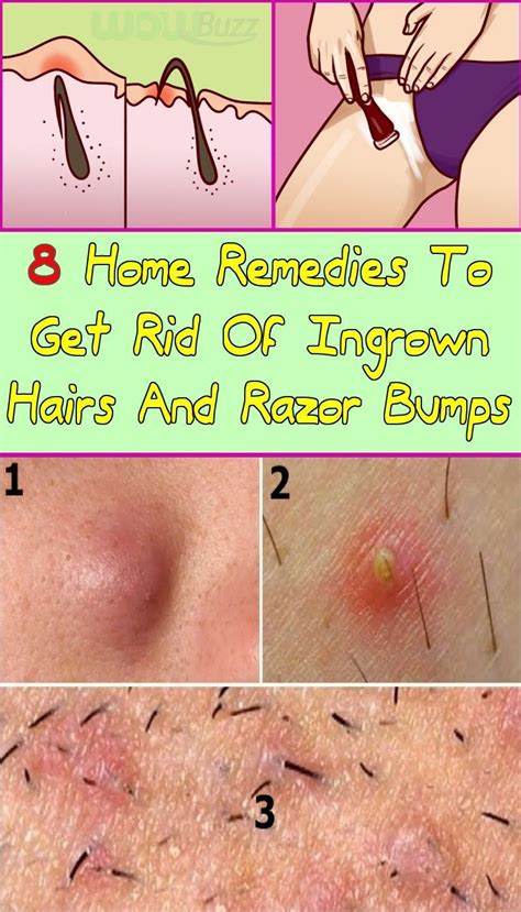 What Are The Red Bumps After Shaving at Ruth Settles blog