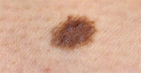 Is it normal for a new mole to appear? Causes and warning signs