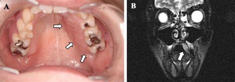 Traumatic neuroma, causes, symptoms, diagnosis, treatment & prognosis