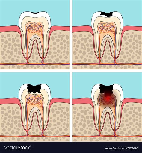 Dental caries stages Royalty Free Vector Image