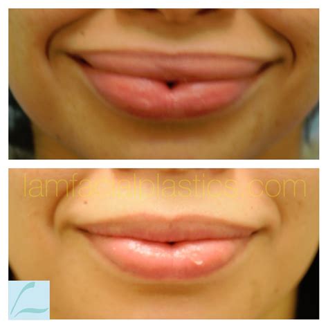 This woman had unsightly and unnatural lip augmentation with silicone liquid. She is shown ...
