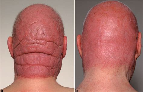 Mycosis Fungoides Pictures And Treatments