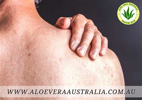 Aloe Vera - Psoriasis Treatment Protocol - Aloe Vera Australia