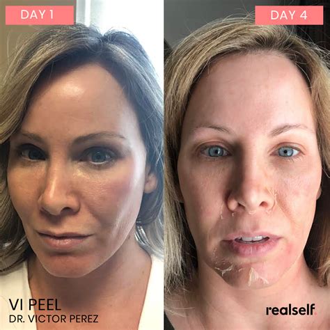 VI Peel: Everything You Need to Know | RealSelf | Face peel, Facial ...