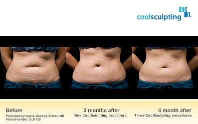 Coolsculpting by Zeltiq Procedure Miami South Florida