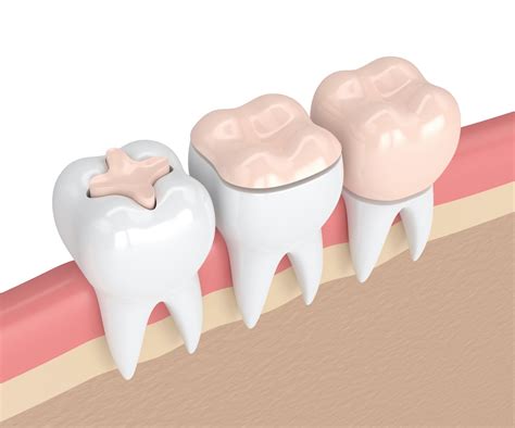 Dental Filling vs. Crown: Which is Right For Me?