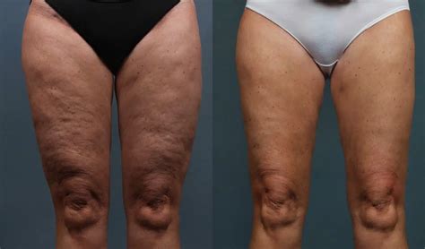 Cellulite Reduction Treatment | Doctor Roya | New York City