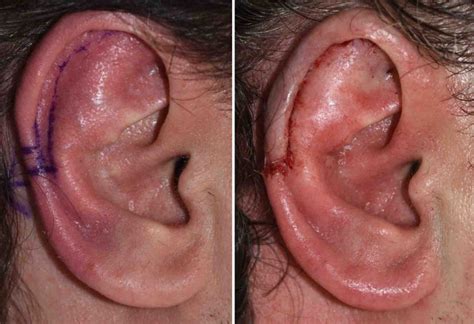 Vertical Ear Reduction with Reverse Otoplasty result side view Dr Barry Eppley Indianapolis ...