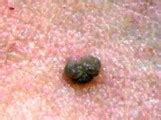 Need to Know Skin Tag Infection Information – Skintagsgone.com