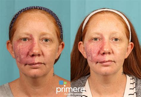 Pulsed Dye Laser (Candela V-Beam) Before and After Pictures Case 740 ...