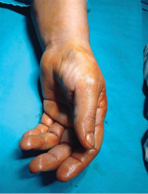 Thenar hypotrophy is seen in a patient with Carpal Tunnel Syndrome ...