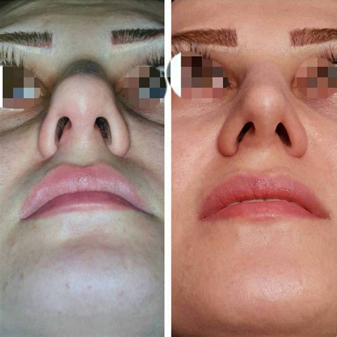 Before And After Bulbous Tip Rhinoplasty » Rhinoplasty: Cost, Pics ...