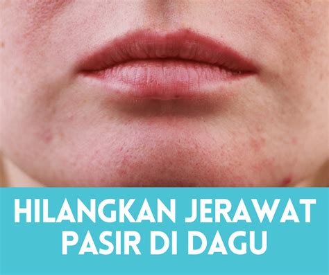 Cara Menghilangkan Jerawat Pasir Di Dahi, Dagu, & Pipi • Portal ...