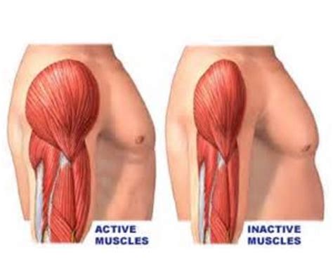 Are you Suffering from Muscle Atrophy? | hubpages