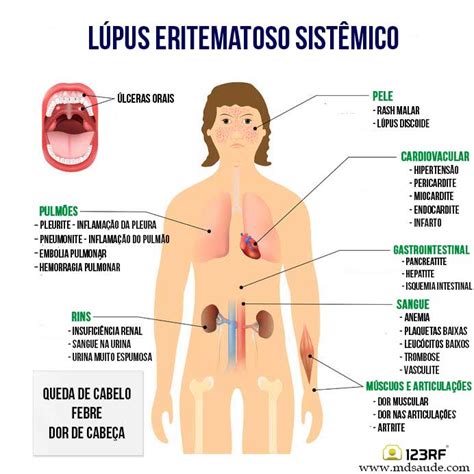 LÚPUS ERITEMATOSO SISTÊMICO - Sintomas e Tratamento » MD.Saúde