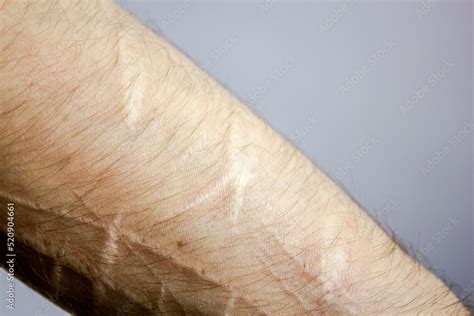 Scars from cuts on the arm. suicide.Cut marks on arms. Stock Photo | Adobe Stock