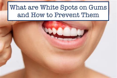 What are White Spots on Gums and How to Prevent Them