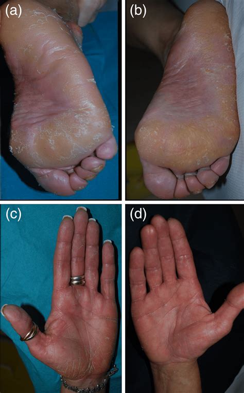 (a and b) Keratoderma and diffuse scaling of both palms and soles ...