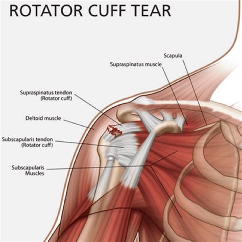 A smart patch that promotes shoulder repair - Oxford Sparks