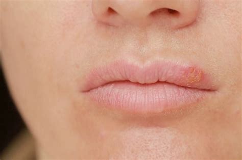 Lip Dermatitis - 7 Natural Home Remedies For Lips Eczema (With images) | Lip dermatitis, Eczema ...