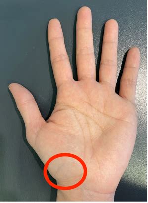 Arthritis of the thumb base / Basal thumb arthritis - Kinetic Orthopaedics