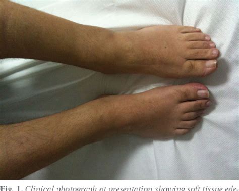 Figure 1 from High-resolution ultrasound of the ankles in Lofgren syndrome: attention to detail ...