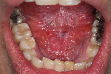 Erythroplakia Floor Of Mouth