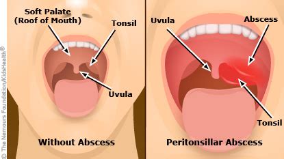 Peritonsillar Abscess (for Parents) - Rady Children's Hospital (XML)