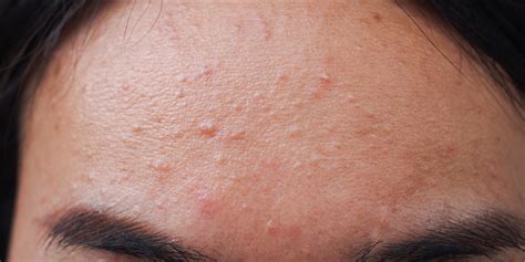 Fungal Acne: Causes, Symptoms, Treatments & Prevention