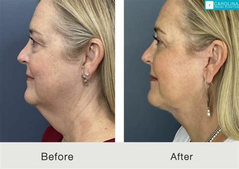 Neck Lift Recovery Day by Day - Carolina Facial Plastics