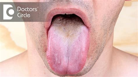 Diagnosis & management of tongue lesions - Dr. Jayaprakash Ittigi - YouTube