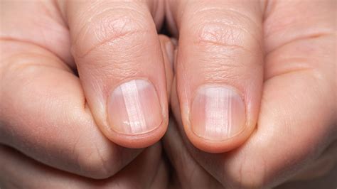 What Those Ridges On Your Fingernails Really Mean