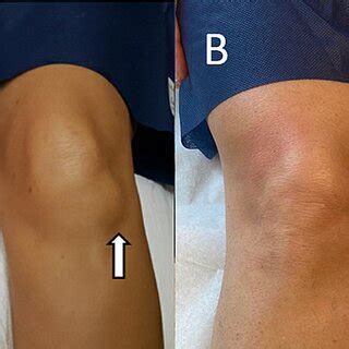 A: Preinjection knee showing ganglion cyst (arrow). B: Postinjection... | Download Scientific ...