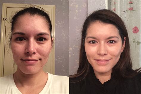 How to Get the Most Out of Tretinoin - okemo56’s diary