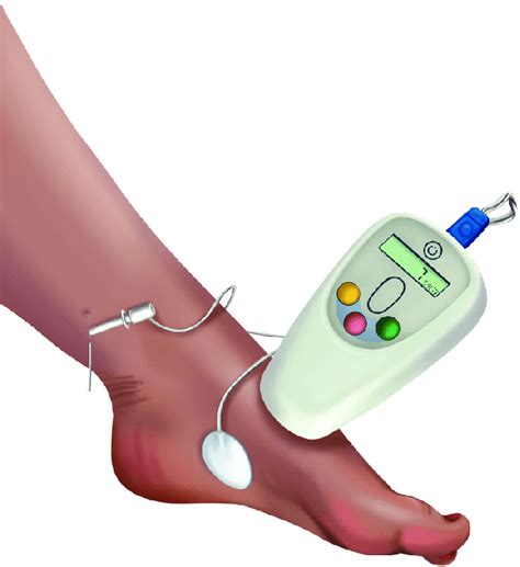 Posterior tibial nerve stimulation. | Download Scientific Diagram