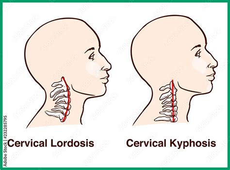 Normal vs. Reversal of Cervical Lordosis Stock-Vektorgrafik | Adobe Stock