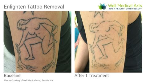 Come say hello and then say goodbye to that nagging tattoo. Call 206-935-5689 to schedule your ...