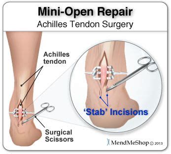 During a mini-open Achilles tendon repair surgery, 2 to 8 small stab ...