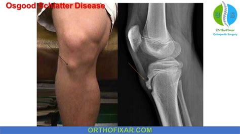 Osgood Schlatter Disease - Full Detailed | OrthoFixar 2024