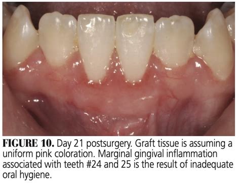 Healing Progression of the Free Gingival Graft - Decisions in Dentistry