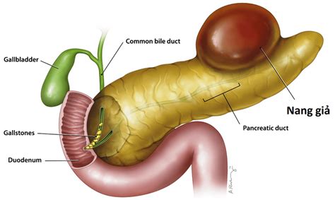 Pancreatic Pseudocyst