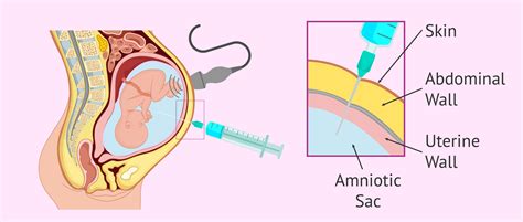 amniocentesis in pregnancy