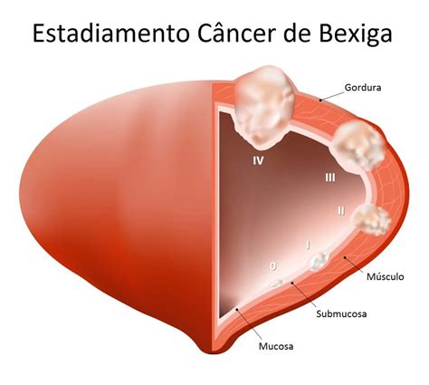 RTU ou Ressecção da Bexiga - Clinica Guidoni