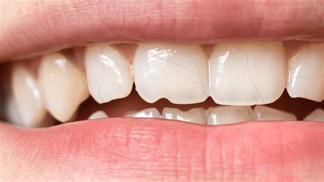 What Are Lines In Your Teeth at Mary Bushnell blog