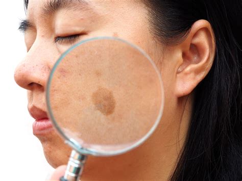 Oral Tranexamic Acid May Be a Treatment for Melasma in Patients With Concomitant Vitiligo ...