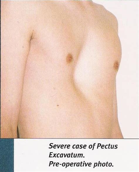 Pectus Excavatum Repair Part 1 - Exercises to Improve Chest Appearance | HubPages