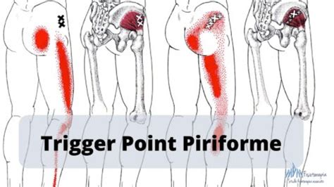 Trigger Point Piriforme | Scopri come agire! - Mdm Fisioterapia