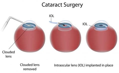 What types of cataract surgery are there?: Lowcountry Eye Specialists ...