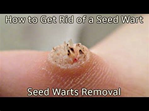 Seed Wart On Hand - naianecosta16